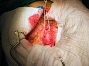 پنجاب میں اینڈو ویسکیولر اینوریزم کے جدید ترین علاج کا آغاز کردیا گیا