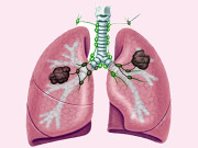 پھیپھڑوں کا کینسر نجات کا خفیہ ہتھیار شادی ہے   
