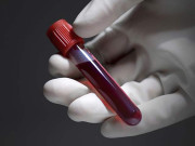 صرف ایک بلڈ ٹیسٹ سے 8 اقسام کے کینسر کی تشخیص