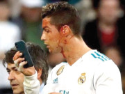 کرسٹیانو رونالڈو دورانِ میچ زخمی ڈاکٹر کے موبائل پر اپنا خون آلود چہرہ دیکھا