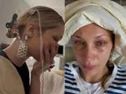 بیلا حدید کونسی بیماری میں مبتلا ہیں؟ اسپتال سے تصاویر شیئر کردیں