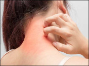 خارش انفرادی بھی اجتماعی بھی