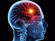 دماغ میں ڈیوائس لگا کر رعشہ کے مریضوں کا کامیاب علاج