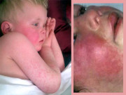 لال بُخار پانچ سے پندرہ سال کے بچے زیادہ متاثر ہوتے ہیں