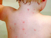 چکن پوکس ویکسینیشن اس سے بچاؤ کا واحد ذریعہ ہے