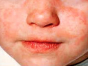 پنجابخسرہ کے9 ہزار مریضوں کا انکشاف مزید 3 بچے جاں بحق  