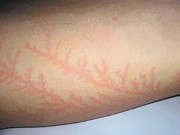 آسمانی بجلی سے انسانی جسم پر بننے والے ٹیٹو