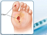  ہر سال شوگر کے لاکھوں مریض پائوں کٹوا بیٹھتے ہیں