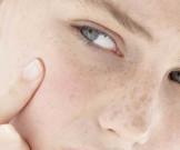 موسم کی تبدیلی سے شہری جلدی امراض میں مبتلا ہونے لگے