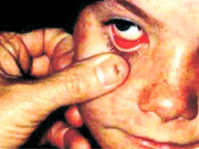 ٹنڈو باگو کے نواحی گائوں میں جلدی بیماری سے 2 بچے جاں بحق 