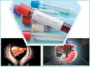 کالے یرقان سے کیسے محفوظ رہیں