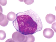 پاکستانی ماہرین نے خون کے کینسر کا سبب بننے والی جین دریافت کرلی