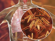 تپ دق کا پھیلاؤ