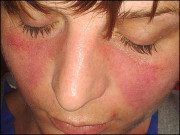 لیوپس ایک جان لیوا بیماری