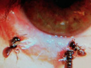 خاتون کی آنکھ میں زندہ مکھیوں کا انکشاف