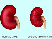 ذیابیطس ٹائپ ٹو کے مریضوں میں گردوں کی حفاظت کرنے والی دوا