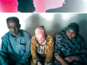 تیزاب گردی 22سالہ لڑکی جعلی پیر کی انا کی بھینٹ چڑھ گئی