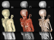 fibrodysplasia ossificans progressiva fop آخر یہ کیا بیماری ہے