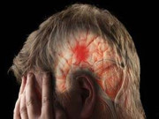 پاکستان میں سالانہ ساڑھے 3 لاکھ افراد فالج کاشکار ہوجاتے ہیں، ماہرین