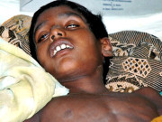 دماغی سوزش بھارت میں سیلاب کے بعد بچوں میں پھیلنے والی بیماری