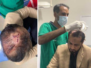 لیگی رہنما خواجہ عمران نذیر حادثے میں زخمی سر پر ٹانکے لگے