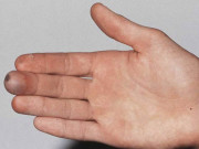 سردی سے اعضا کو منجمد ہونے سے بچانے والا اسپرے تیار