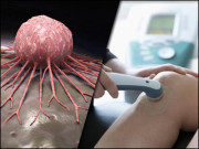 کیا الٹرا ساؤنڈ سے کینسر کا علاج بھی ہوسکے گا