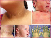 acanthosis nigricans