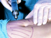 قدرتی موٹاپے سے نجات کیلئے لائپو سکشن نہیں کروانا چاہئے  