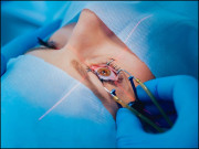 آنکھوں کی لیزر سرجری اور ابہام