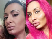روسی ماڈل انجیکشن کے بعد سوجے ہوئے گالوں سے بھی خوش اور مطمئن