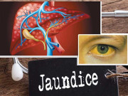 یرقان اسباب علامات اورعلاج کیا ہے