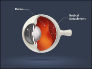 نینو ذرّات سے آنکھ کے پردے کی مرمت اور بینائی کی بحالی