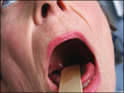 منہ میں خراشیں بھی کورونا وائرس کی علامت ہوسکتی ہیں تحقیق