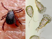 نگلیریا اور کانگو وائرس پھیلنے کا خدشہ جرثومے نے مریض کا دماغ کھا لیا