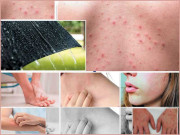 موسم برسات میں جلدی امراض سے کیسے رہیں محفوظ