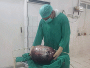 منگلا میں مریض کے پیٹ سے 24 کلو وزنی رسولی نکال لی گئی