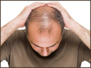سر کے بال گرنے کیسے روکے جائیں