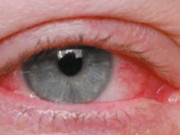 آشوبِ چشم علامات احتیاط اور علاج