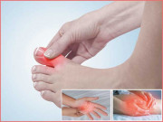 یورک ایسڈ کا علاج غذا سے کیجئے