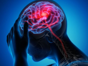 پاکستان میں پہلی بار فالج کے مریض کے دماغ میں اسٹنٹ ڈالا جائے گا