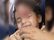 کراچی 5 سالہ بچی کو آوارہ کتے نے بھنبھوڑ ڈالا