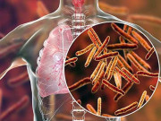 ٹی بی ایک قابل علاج مرض