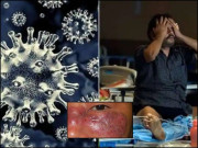 میوکور مائیکوسز اور کورونا کا رشتہ