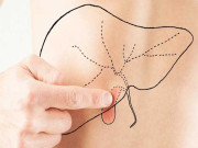 پتے کی پتھری کی وجوہات اور ان کا علاج