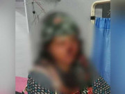 گوجر خان میں سابق شوہر نے خاتون کی ناک کاٹ ڈالی