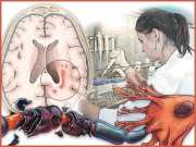 قدیم دماغی مرض ’’ملٹی پل اسکلروسیس‘‘ کیا ہے