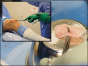 ناک کی ہڈی سے گھٹنوں میں گٹھیا کا علاج