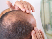 مرغن غذا کم کھائیں اوراپنے بال بچائیں