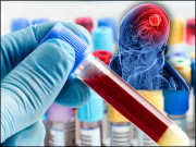 خون میں دماغی بیماریوں کی علامات موجود ہوتی ہیں تحقیق